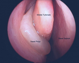 Euforea | Chronic Rhinosinusitis with Nasal Polyps (CRSwNP)